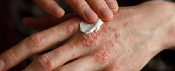eczema lotion hands filaggrin 600