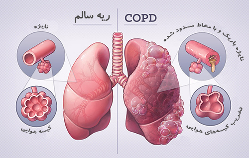 Healthy vs COPD