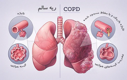 Healthy vs COPD