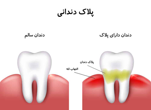 پلاک-دندانی