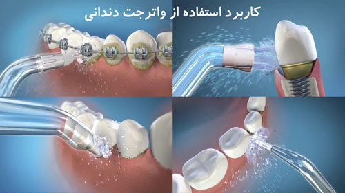 کاربرد-استفاده-از-واترجت-دندانی