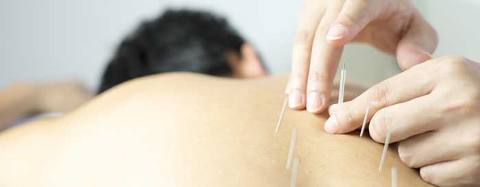 فیزیوتراپی چیست و چه کاربردی دارد؟ 8 طب سوزنی